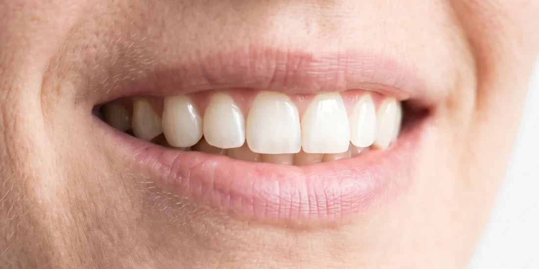 After: natural, even front teeth, one shade lighter