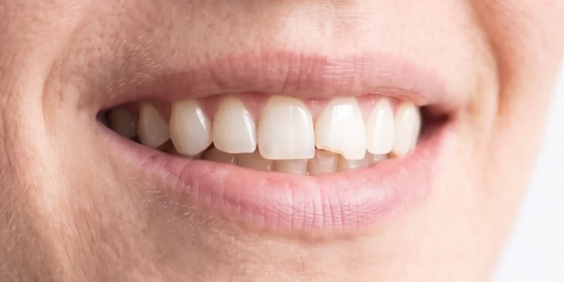 Before: worn, chipped front teeth with a small gap